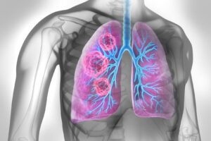 Lung-dwelling bacteria could promote cancer growth