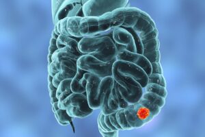 How a gut commensal contributes to colorectal cancer