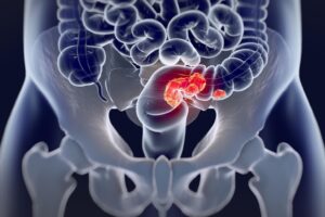 Gut microbes could be used to predict colorectal cancer