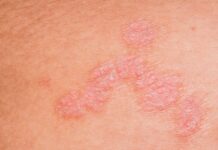 Cutaneous and intestinal dysbiosis cause skin inflammatory diseases