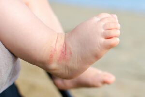 Skin bacteria could help diagnose childhood eczema