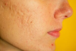 Acne may be caused by a lapse in the skin-microbiota dialogue
