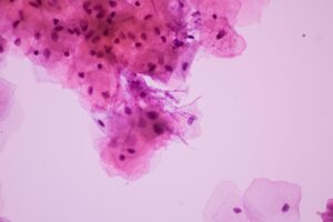Vaginal fluid transplant could help cure bacterial vaginosis