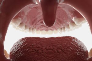 Mouth microbiota composition could predict the outcome of stem cell transplants