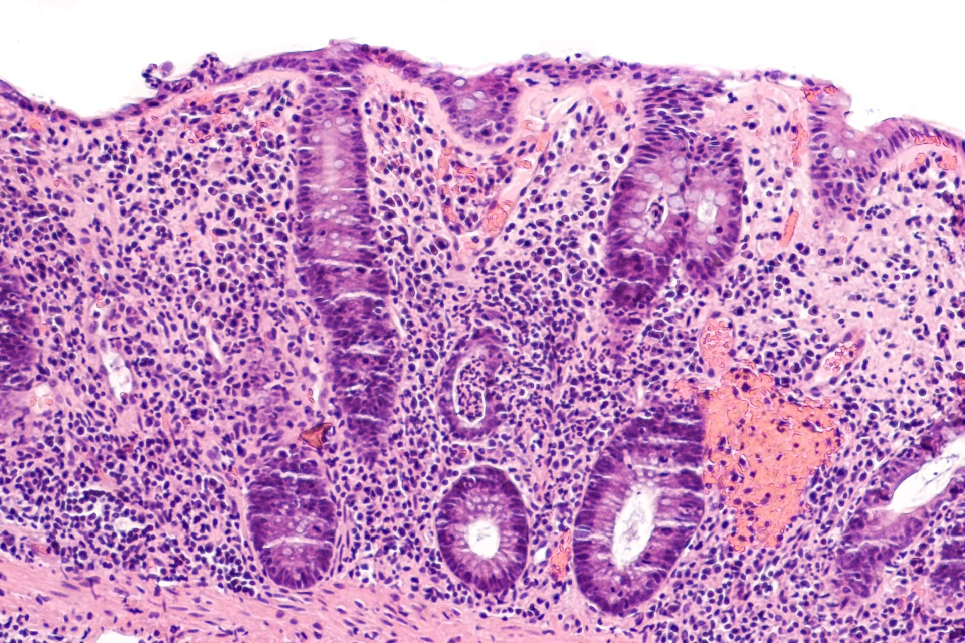 two-pronged-approach-may-help-to-treat-inflammatory-bowel-disease