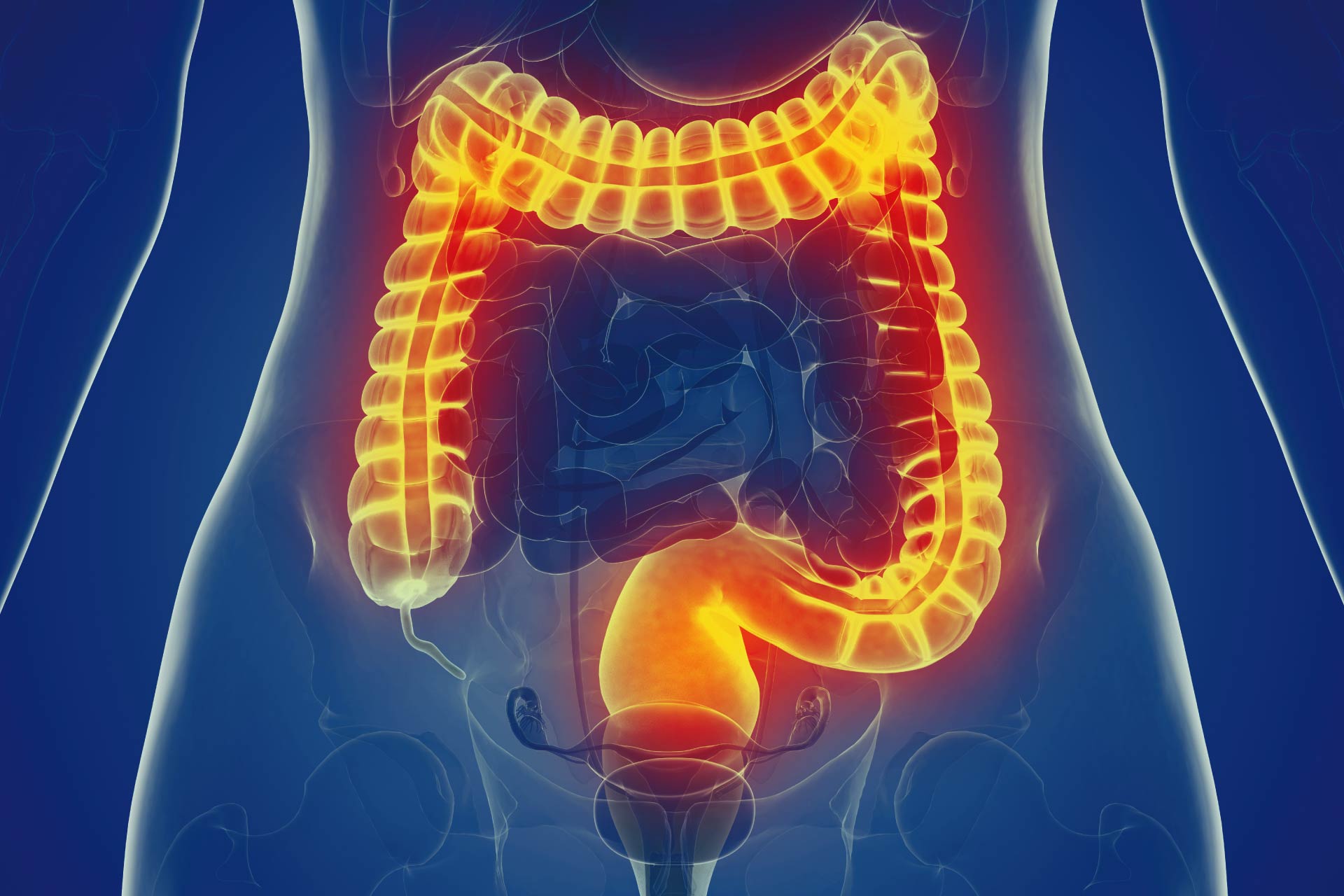 Specific Gut Bacteria Are Associated With Inflammatory Bowel Disease