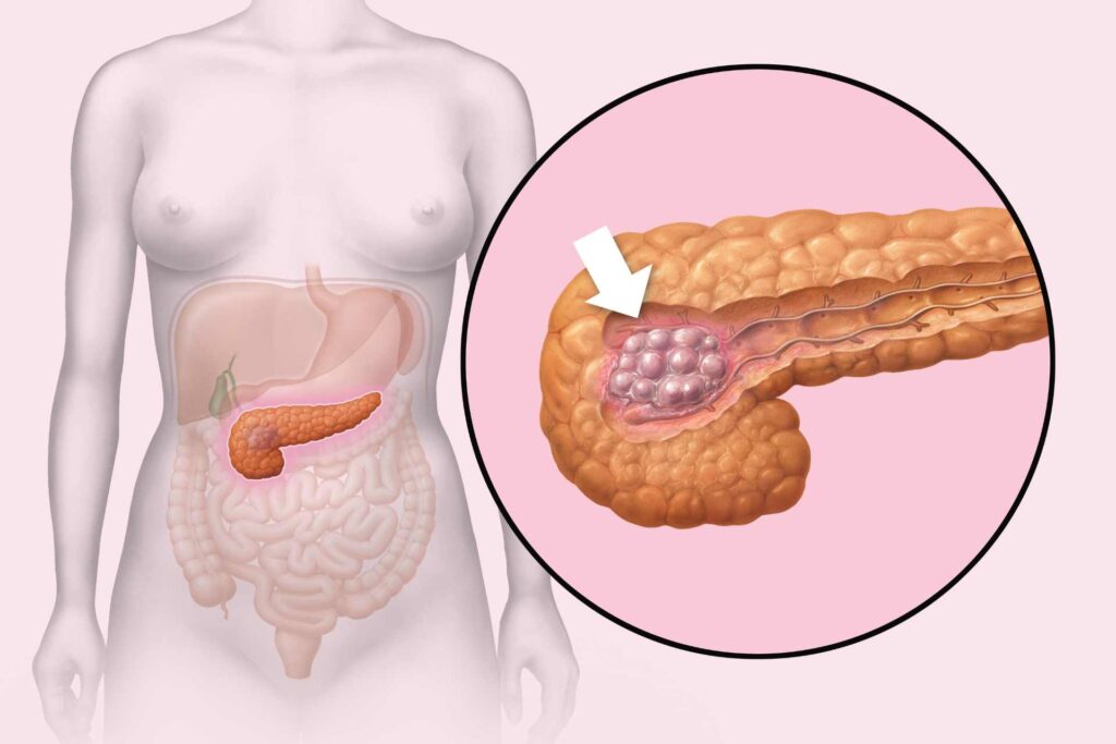 Tumor microbiota interactions may help to identify new treatments for