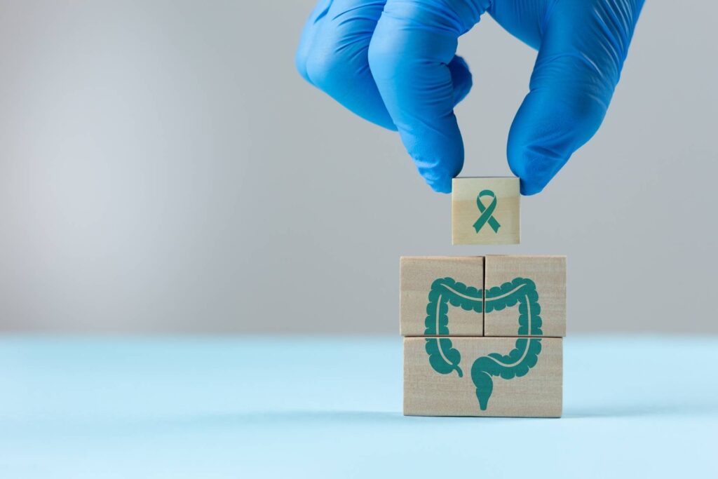 Simple rectal mucus test shows promise for detecting colon cancer 