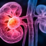 Healthy donor fecal transplants may boost immunotherapy in kidney cancer