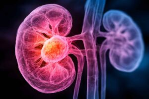 Healthy donor fecal transplants may boost immunotherapy in kidney cancer