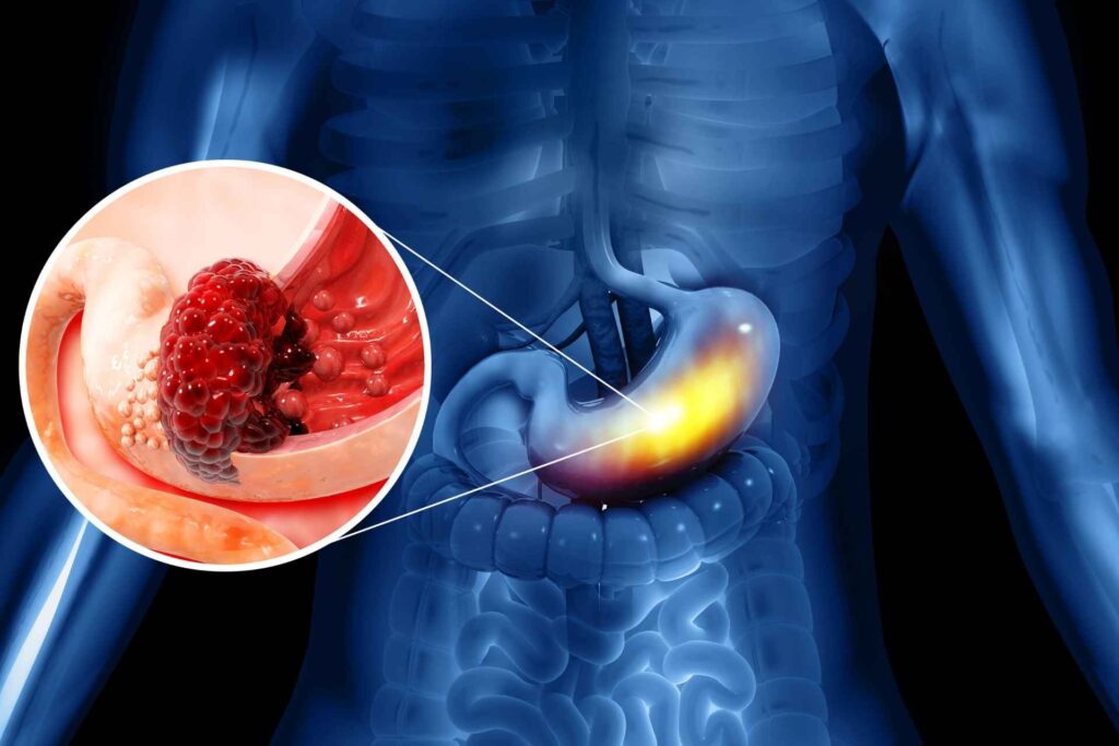 Microbial particles may boost the effectiveness of immunotherapy in stomach cancer