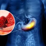 Microbial particles may boost the effectiveness of immunotherapy in stomach cancer