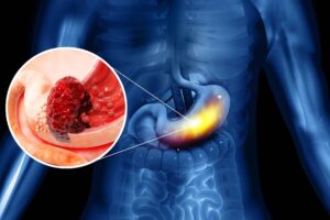 Microbial particles may boost the effectiveness of immunotherapy in stomach cancer