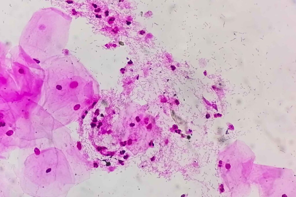 Probiotics may help prevent bacterial vaginosis, small clinical study finds
