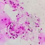 Probiotics may help prevent bacterial vaginosis, small clinical study finds