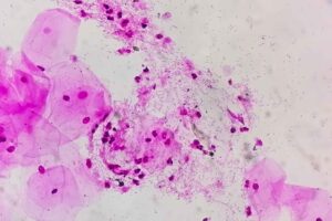 Probiotics may help prevent bacterial vaginosis, small clinical study finds