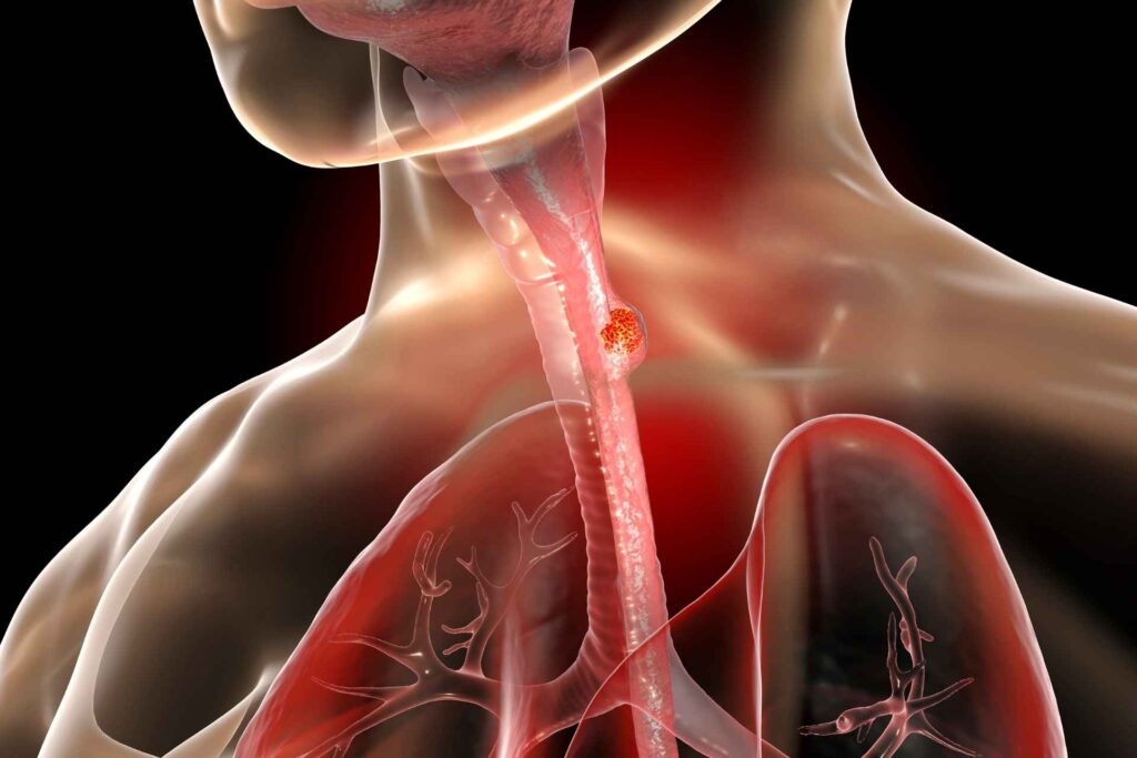 Gut bacterium may weaken treatment responses in esophageal cancer