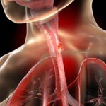 Gut bacterium may weaken treatment responses in esophageal cancer