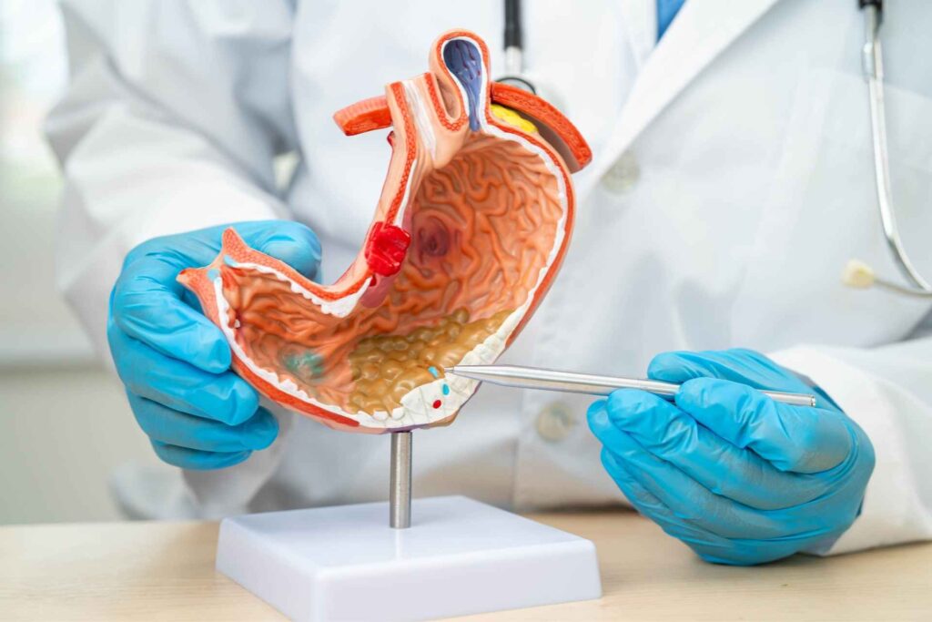Mouth bacteria may migrate to the gut and help drive gastric cancer