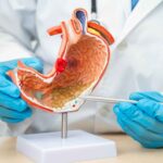 Mouth bacteria may migrate to the gut and help drive gastric cancer