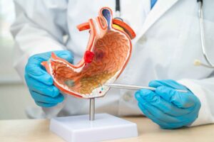 Mouth bacteria may migrate to the gut and help drive gastric cancer