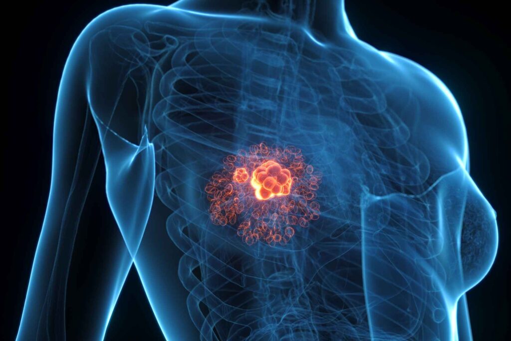 Gut bacteria metabolite may help breast cancer to grow
