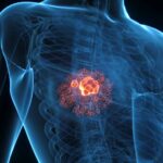 Gut bacteria metabolite may help breast cancer to grow