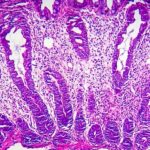 Precancerous growths may trigger long-lasting changes on the gut microbiota