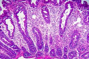 Precancerous growths may trigger long-lasting changes on the gut microbiota